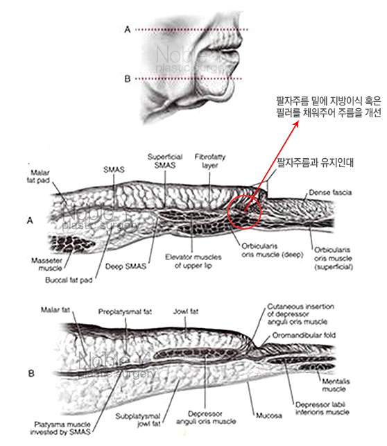 팔자주름