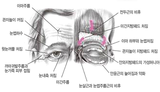 이마눈썹거상술