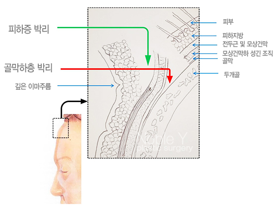 이마눈썹거상술