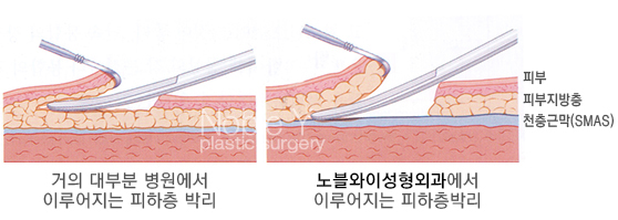 목주름