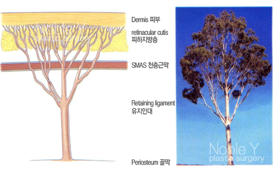 볼처짐(안면거상술)