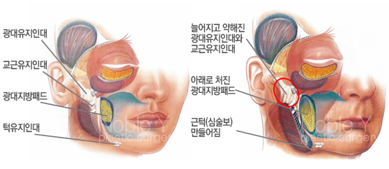 볼처짐(안면거상술)