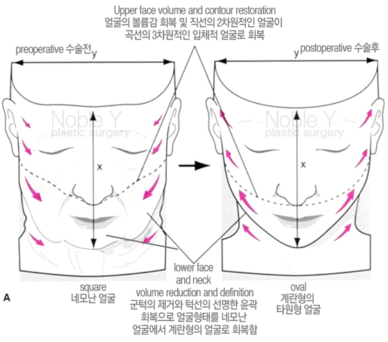 볼처짐(안면거상술)