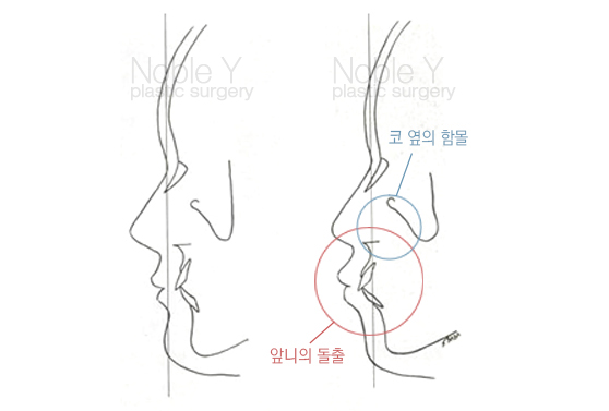 귀족수술