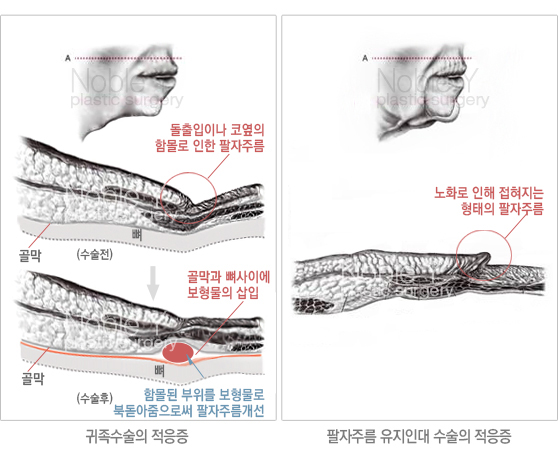 귀족수술